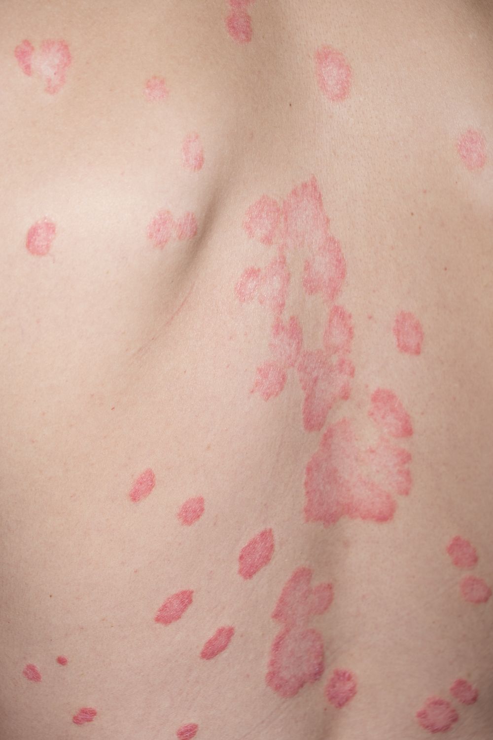 autoimmune conditions - psoriasis
